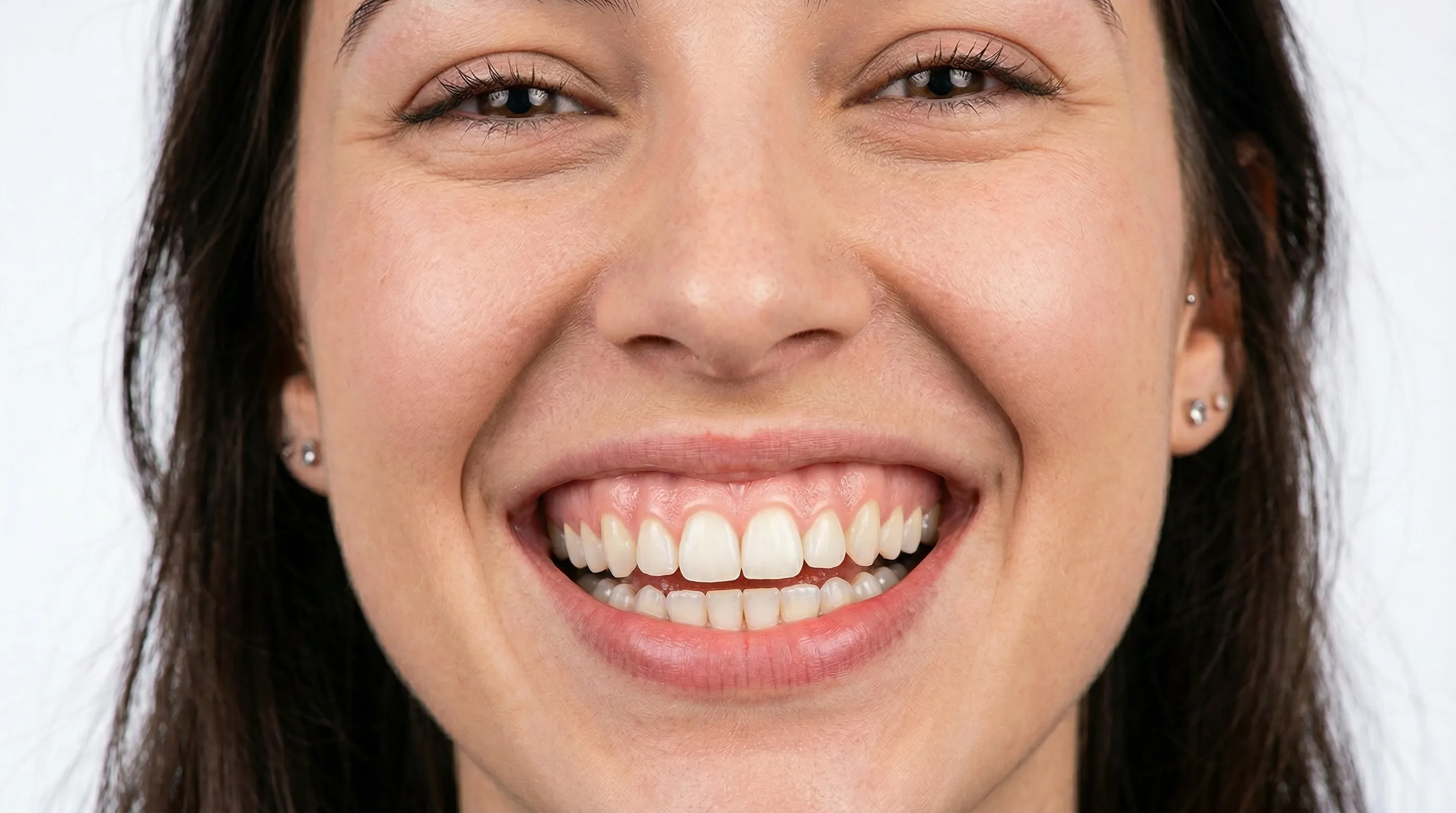 Close-up showing white spots on tooth enamel
