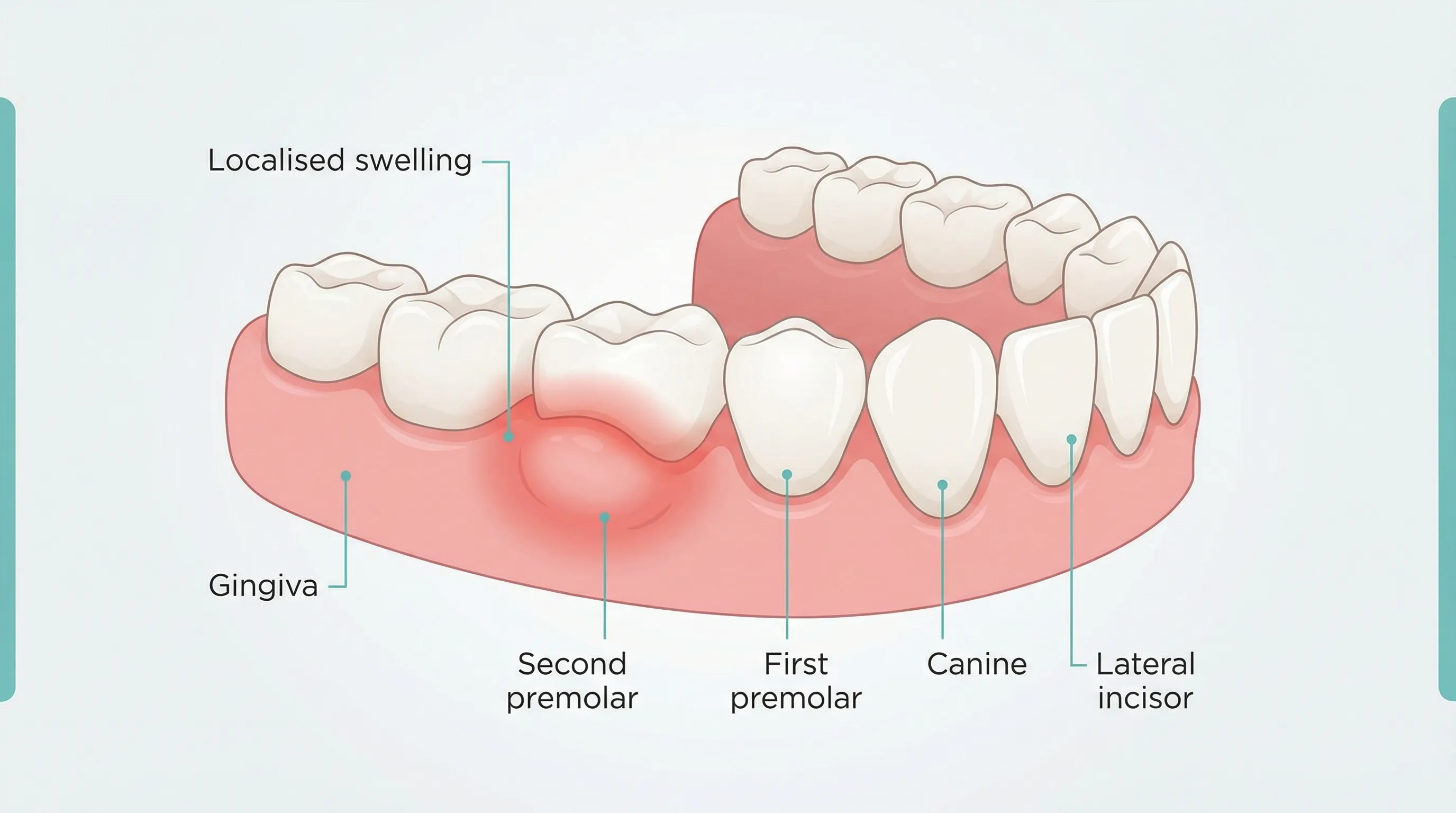 Close-up showing swollen gum tissue around a single tooth